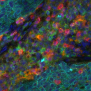Different types of T cells (red, green, pink, orange) in the tumor microenvironment. Most T cells that surround the tumor are unable to infiltrate into the tumor (cyan & blue). 