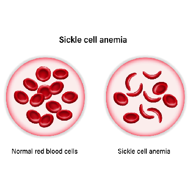 Side-by-side comparison of normal red blood cells and sickle cell anemia.