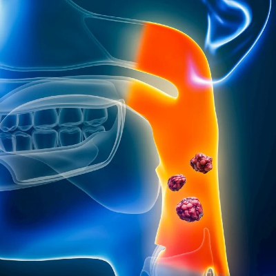 graphic of X-ray of human head with throat area highlighted in orange.  Three clusters of cells are centered in the orange area.