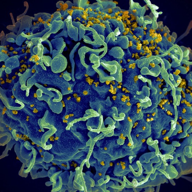 HIV viruses attack a human T cell